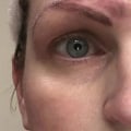 Can microblading be corrected?