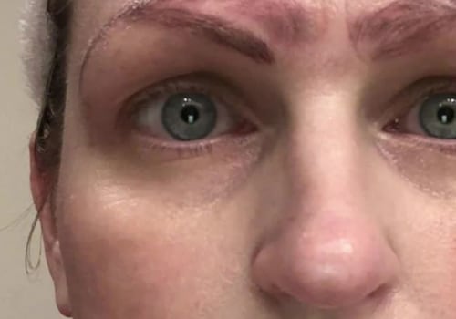 Can microblading eyebrows be reversed?